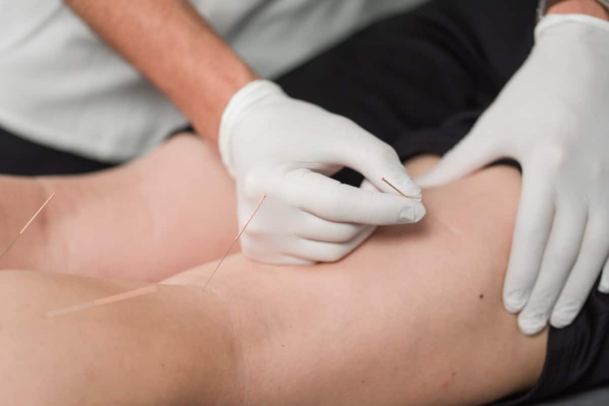 Dry Needling at Stride Physiotherapy and Wellness